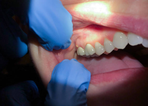 Best Dental Abscess Treatment in Seeley, CA